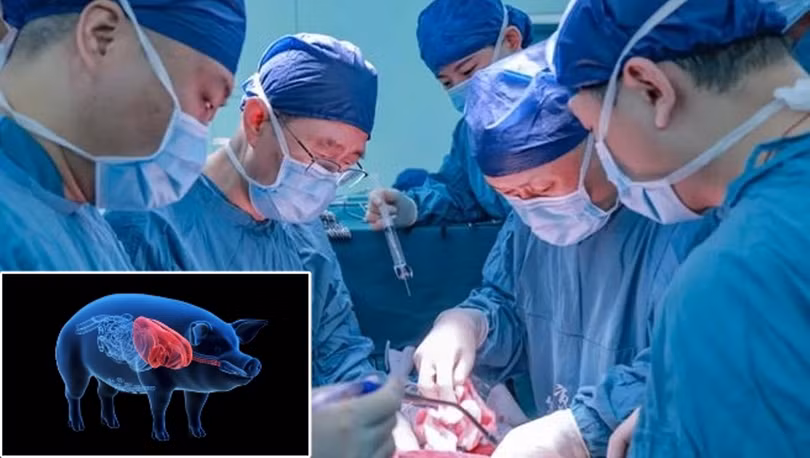 Nhóm khoa học Đại học Y khoa An Huy đã thực hiện thành công ca ghép gan lợn đã chỉnh sửa gene cho bệnh nhân ung thư (Ảnh: Guangming)