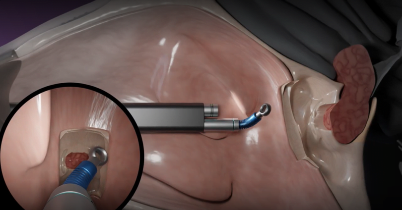 Bức ảnh cho thấy hệ thống Tamar Robotics, được sử dụng để loại bỏ một khối u tuyến yên qua mũi. Trong khoanh tròn là chế độ xem mà bác sĩ phẫu thuật nhìn thấy trên màn hình. Ảnh NoCamels