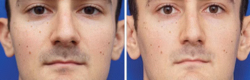 Chụp ảnh tự sướng nhiều sẽ làm mũi bị to ra? ảnh 1