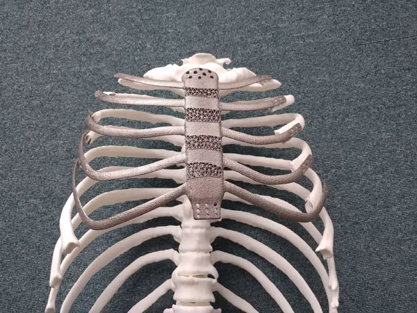 Ca ghép xương ngực nhân tạo bằng công nghệ in 3D đầu tiên tại Hàn Quốc. Ảnh: koreabiomed.com 