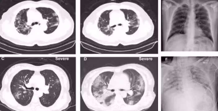 Hình chụp CT phổi của bệnh nhân nhiễm coronavirus. Hình chụp CT phổi của bệnh nhân nhiễm coronavirus.