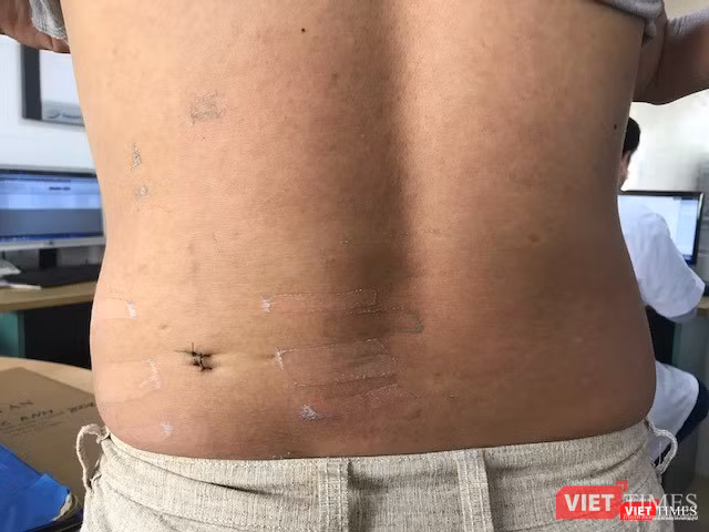 Sau mổ, bệnh nhân hoàn toàn khỏe mạnh, vết mổ nhỏ, ít xâm lấn