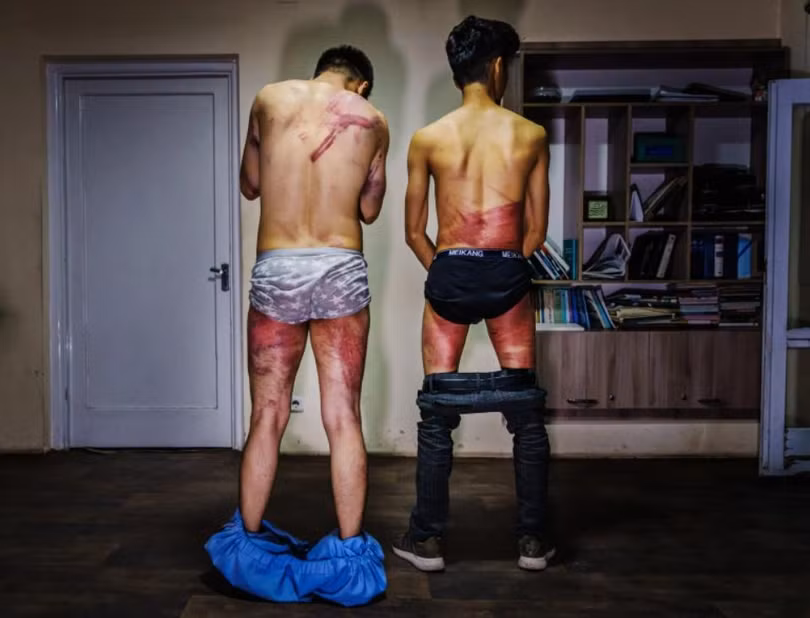 Cơ thể của 2 phóng viên chằng chịt những vết thương do bị đánh đập tàn bạo (Ảnh: Al Jazeera)