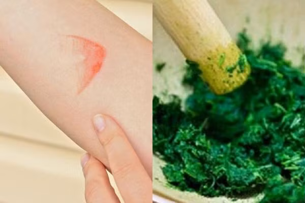 Dân gian thường dùng rau má để trị vết bỏng Dân gian thường dùng rau má để trị vết bỏng