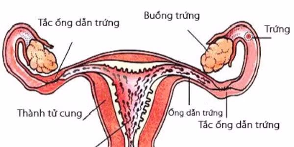 Các bệnh lý phụ khoa dẫn là một trong những nguyên nhâm thầm lặng dẫn đến vô sinh hiếm muộn Các bệnh lý phụ khoa dẫn là một trong những nguyên nhâm thầm lặng dẫn đến vô sinh hiếm muộn