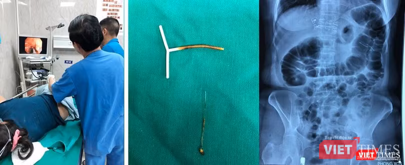 Dị vật là vòng tránh thai đã được lấy ra khỏi đại tràng bệnh nhân. Ảnh: BVCC Dị vật là vòng tránh thai đã được lấy ra khỏi đại tràng bệnh nhân. Ảnh: BVCC