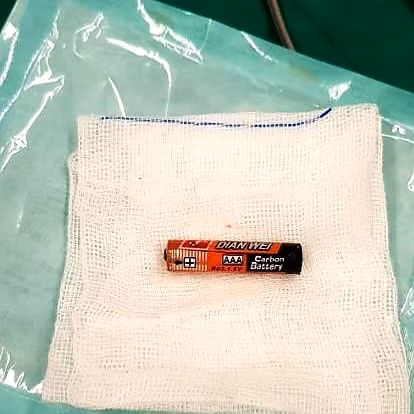 Viên pin con ó được lấy ra khỏi bụng bé gái 4 tuổi. Ảnh: BVCC Viên pin con ó được lấy ra khỏi bụng bé gái 4 tuổi. Ảnh: BVCC