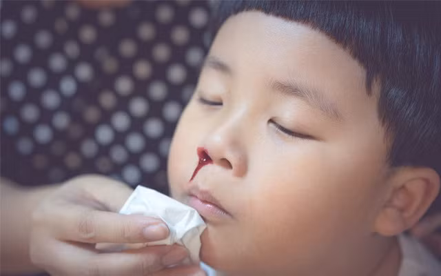 Những triệu chứng ban đầu của bệnh u sợi mạch vòm mũi họng là trẻ dễ bị chảy máu cam khi hắt hơi. Ảnh minh họa: Internet