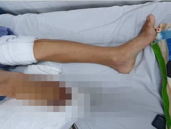 Hình ảnh chân bé trai sau khi đã phẫu thuật thành công. Ảnh: BSCC Hình ảnh chân bé trai sau khi đã phẫu thuật thành công. Ảnh: BSCC