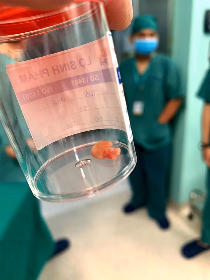Dị vật được lấy ra khỏi đường thở của trẻ. Ảnh: BVCC Dị vật được lấy ra khỏi đường thở của trẻ. Ảnh: BVCC