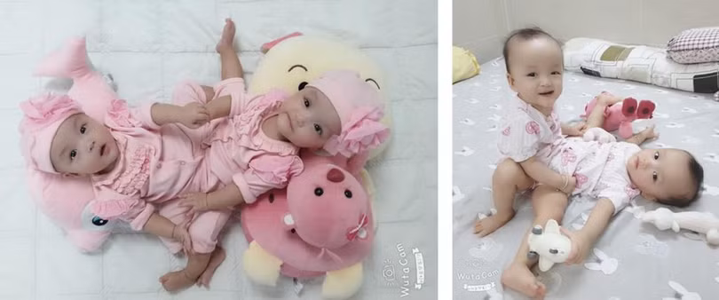 Hình ảnh Trúc Nhi - Diệu Nhi trước khi đại phẫu tách rời. Ảnh: BVCC Hình ảnh Trúc Nhi - Diệu Nhi trước khi đại phẫu tách rời. Ảnh: BVCC