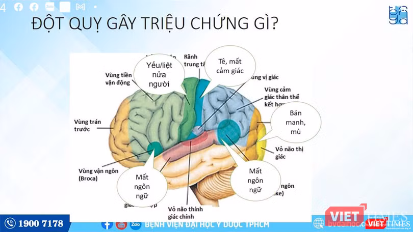 BS Thắng phân tích về các hậu quả nặng nề của bệnh đột quỵ (Ảnh: BVCC) BS Thắng phân tích về các hậu quả nặng nề của bệnh đột quỵ (Ảnh: BVCC)