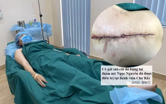Bệnh nhân bị biến chứng nặng nề sau hút mỡ bụng (Ảnh: BSCC) 