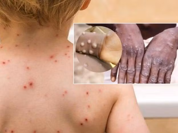 WHO đã tuyên bố tình trạng khẩn cấp toàn cầu với bệnh đậu mùa khỉ WHO đã tuyên bố tình trạng khẩn cấp toàn cầu với bệnh đậu mùa khỉ