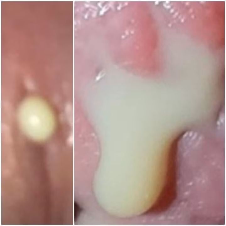 Hình ảnh mủ niệu đạo do lậu gây ra Hình ảnh mủ niệu đạo do lậu gây ra