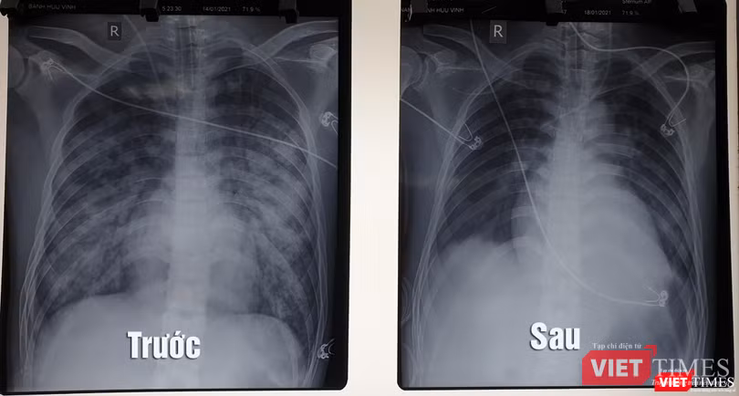 Hình ảnh X quang phổi của bệnh nhân trước và sau khi điều trị bằng kỹ thuật ECMO (Ảnh: BVCC) Hình ảnh X quang phổi của bệnh nhân trước và sau khi điều trị bằng kỹ thuật ECMO (Ảnh: BVCC)