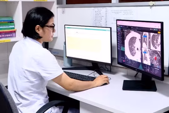 Các bác sĩ ứng dụng AI trong chẩn đoán sớm ung thư phổi. Ảnh: Sở Y tế Hà Nội.