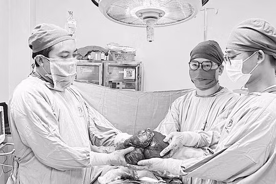 Bụng to dần bất thường, người phụ nữ 68 tuổi phát hiện khối u ác tính 3kg trong ổ bụng