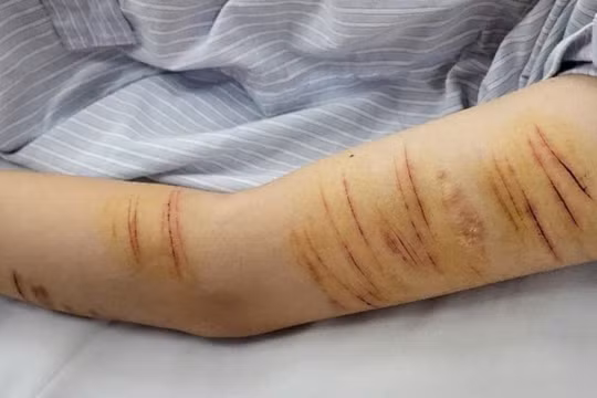 Không nhiểu phụ huynh biết đến căn bệnh tự gây thương tích của trẻ. Ảnh: Viện SKTT.