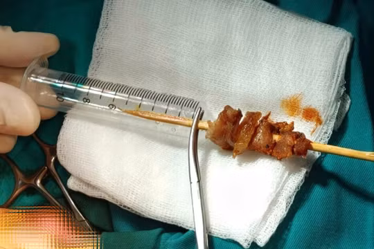 Bé gái suýt mù mắt vì bị ngã khi cầm que thịt nướng