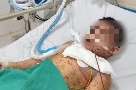Thủy đậu tấn công vào máu, bé trai 6 tuổi nguy kịch