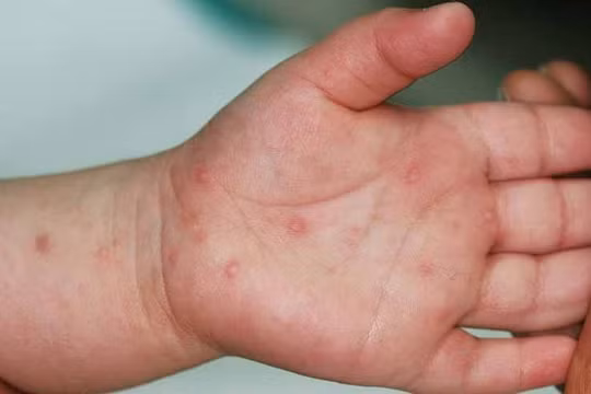 Từ đầu năm đến nay đã có hơn 7.200 ca mắc tay chân miệng, tăng 241,3% so với cùng kỳ năm 2025.