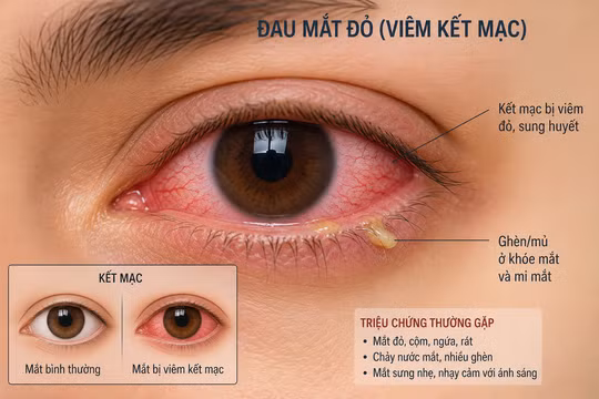 Bệnh đau mắt đỏ gia tăng, Bộ Y tế cảnh báo 7 điều tuyệt đối không được chủ quan 