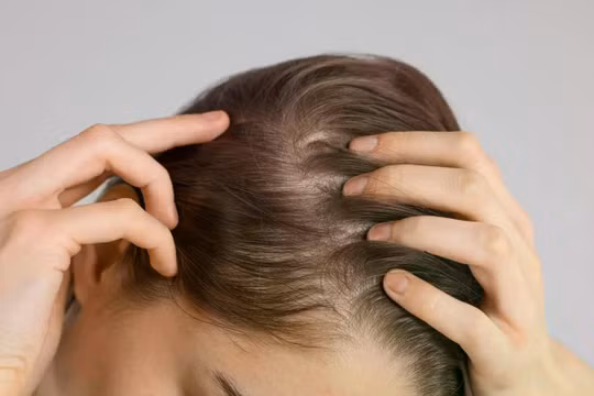 Rụng tóc từng mảng là một bệnh tự miễn dịch, trong đó hệ thống miễn dịch của cơ thể tấn công nhầm vào các nang tóc. Ảnh: Shutterstock.