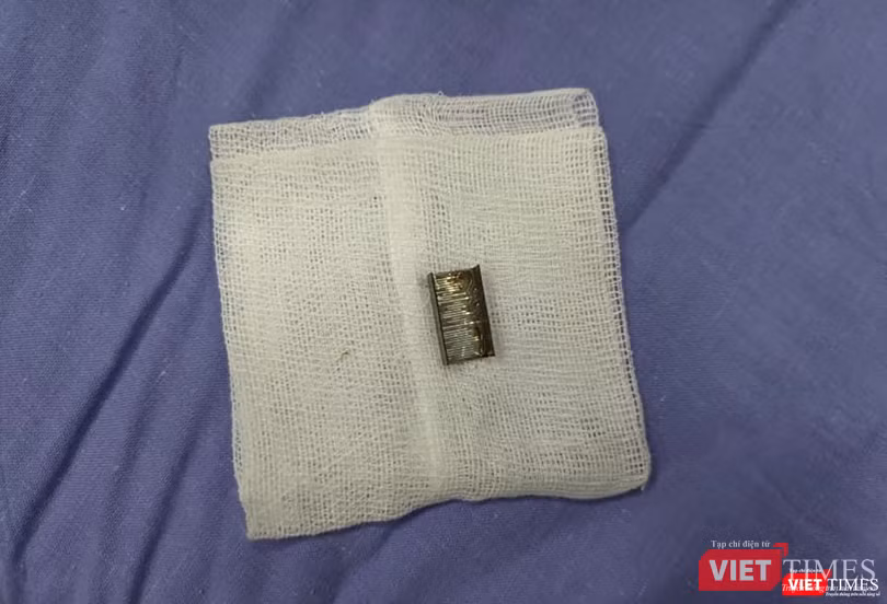 Dị vật mảnh kim loại được nội soi lấy ra từ bệnh nhân nhi nhập viện cấp cứu Dị vật mảnh kim loại được nội soi lấy ra từ bệnh nhân nhi nhập viện cấp cứu