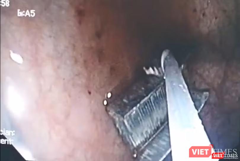 Camera nội soi ghi lại hình ảnh gắp dị vật là vĩ ghim bấm bên trong đường thở của trẻ Camera nội soi ghi lại hình ảnh gắp dị vật là vĩ ghim bấm bên trong đường thở của trẻ