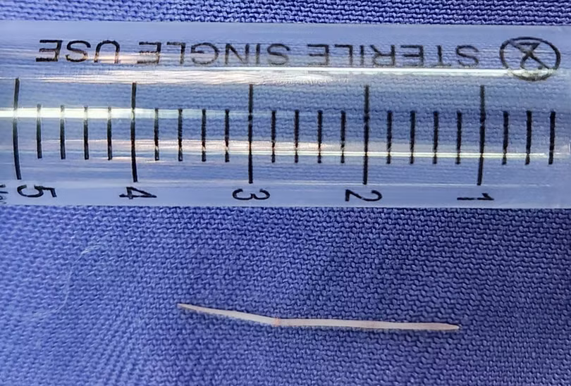 Chiếc xương cá dài 2,5cm được lấy từ sàn miệng bệnh nhân