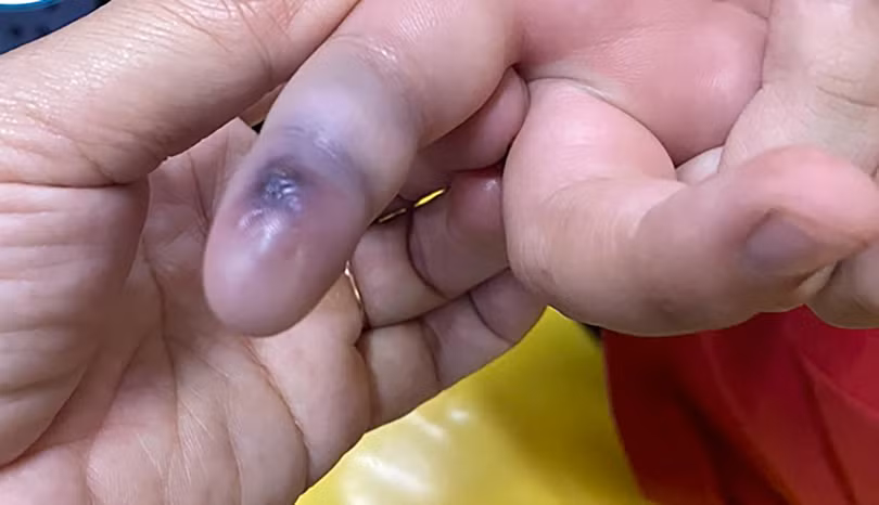 Vết cắn do rắn lục đuôi đỏ để lại (ảnh bệnh viện cung cấp)