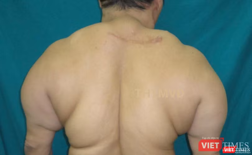 Một trường hợp mắc chứng u mỡ đối xứng hiếm gặp biểu hiện ở vùng gáy và vùng lưng. Một trường hợp mắc chứng u mỡ đối xứng hiếm gặp biểu hiện ở vùng gáy và vùng lưng.