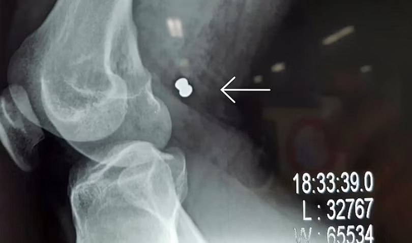 Phim X-ray chụp viên đạn ghim vào đùi gây vở động mạch và tĩnh mạch đùi của bạn nhân