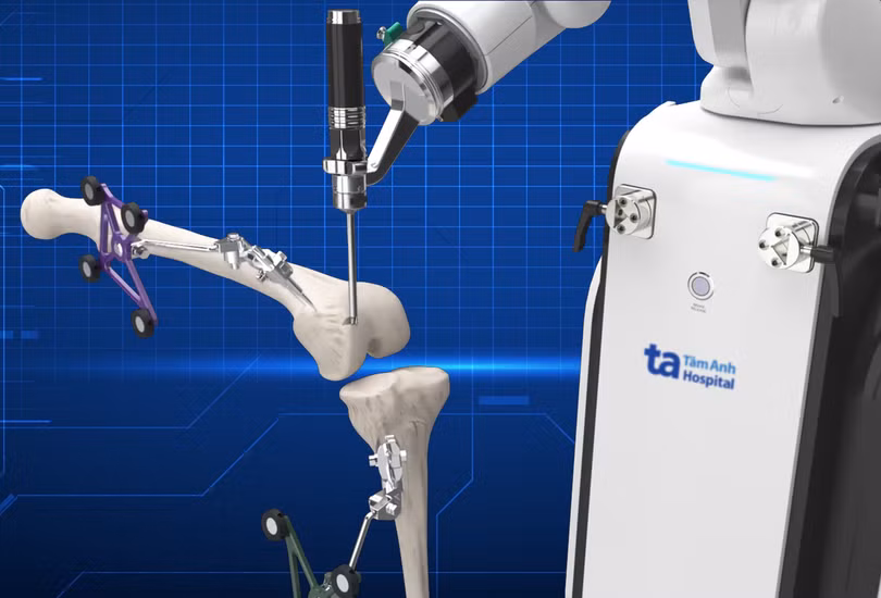 Mô phỏng robot AI chủ động cắt xương thay khớp chuẩn xác từng milimet theo kế hoạch được bác sĩ phê duyệt. Ảnh: Bệnh viện Đa khoa Tâm Anh