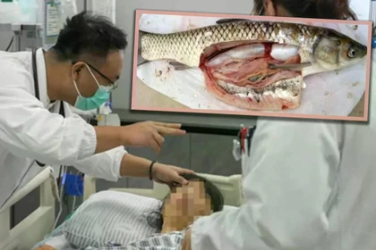 Một phụ nữ Trung Quốc đã nuốt túi mật cá sống với niềm tin rằng nó sẽ giúp giảm đau đầu, nhưng cuối cùng phải nhập viện cấp cứu do nhiễm độc. Ảnh: SCMP.