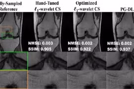 Đại học Minnesota Twin Cities đưa ra giải pháp nâng cao hiệu suất cho phép chụp MRI nhanh hơn không sử dụng các phương pháp học sâu mới hơn. Ảnh: Phòng thí nghiệm xử lý hình ảnh và hình ảnh y tế thông minh, Đại học Minnesota