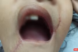 Tổn thương vùng miệng của bé T. đã được các bác sĩ xử trí.