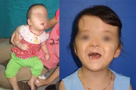 Bệnh nhi trước và sau khi phẫu thuật