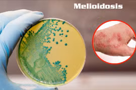 Ảnh minh họa bệnh Melioidosis (hay còn gọi là bệnh Whitmore).
