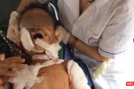 Một trường hợp trẻ em bị thương nặng do chó nhà tấn công