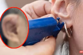 Bệnh nhân bị biến chứng do bấm lỗ tai sai vị trí, không đảm bảo vệ sinh