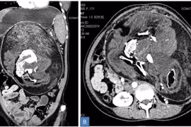 Hình ảnh CT scan trường hợp "thai nhi trong bào thai" được phát hiện bên trong bụng của một người phụ nữ Ấn Độ. Ảnh: Gizmodo