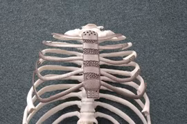 Ca ghép xương ngực nhân tạo bằng công nghệ in 3D đầu tiên tại Hàn Quốc. Ảnh: koreabiomed.com 