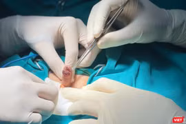 Ca phẫu thuật cắt bỏ khối sùi mào gà dương vật cho bệnh nhi 6 tuổi, giúp bệnh nhân tránh nguy cơ cắt cụt dương vật.