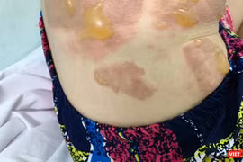 Thương tích trên người nạn nhân Đặng Thị Ngọc L.y