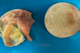 Túi ngực vỡ của chị V. được lấy ra sau 5 năm phẫu thuật nâng ngực (Ảnh - Bệnh viện Hữu nghị Việt Đức) 