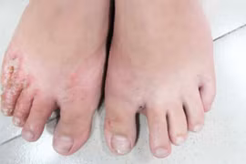 Bệnh nhân bị nấm chân (Ảnh: BS. Lê Thị Mai) 