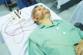 Bệnh nhân bị liệt mặt điều trị ở bệnh viện (Ảnh: BVCC)