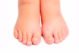 Phù, nề khiến cơ thể sưng đau khó chịu 